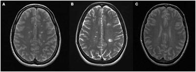 Antiphospholipid Antibodies Overlapping in Isolated Neurological Syndrome and Multiple Sclerosis: Neurobiological Insights and Diagnostic Challenges